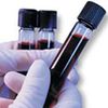 Mislabeled Blood Samples, 920 Patients To Be Retested